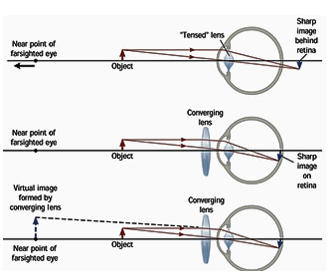 myopia ray diagram